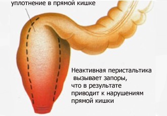 Атония кишечника - это отсутствие нормальной перистальтики Атония