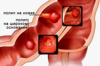 Полипы в кишечнике считаются редкой патологией и представляют собой наросты разного размера Полипы