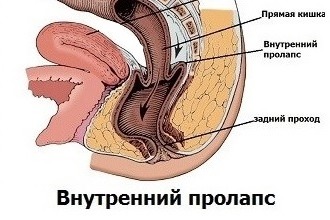 Внутреннее выпадение может возникать и у мужчин, и у женщин Внутреннее выпадение