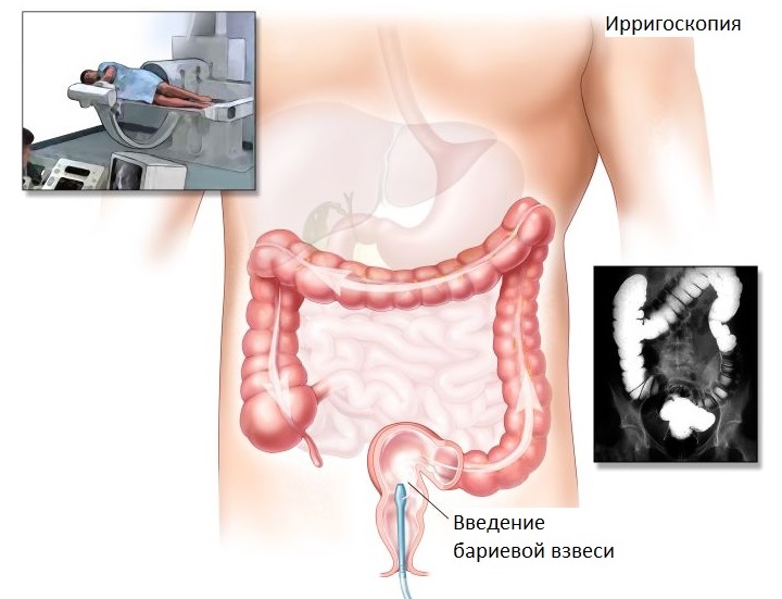 Выбор аппаратной методики зависит от степени проявления симптоматики Схема