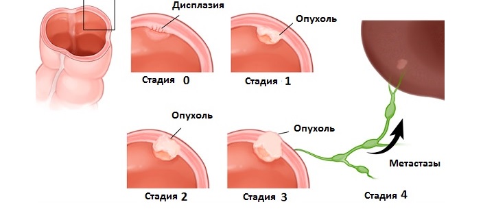 Полипы бывают различных видов, многие из которых (аденомы) в последствии могут переродиться в рак Полипы