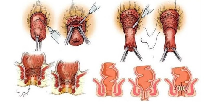 Операция Делорма при выпадении прямой кишки Операция Делорма