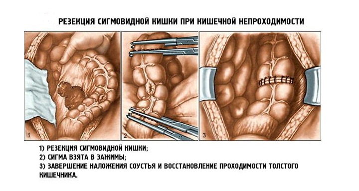 Резекция сигмовидной кишки Схема