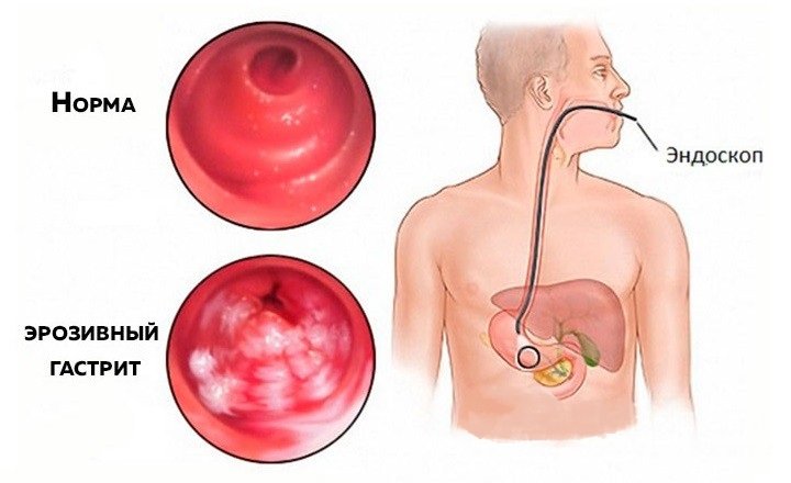 Эзофагогастродуоденоскопия для диагностики гастрита Гастроскопия