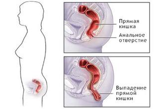 Выпадение прямой кишки у детей – одна из самых распространенных проблем в колопроктологии Схема