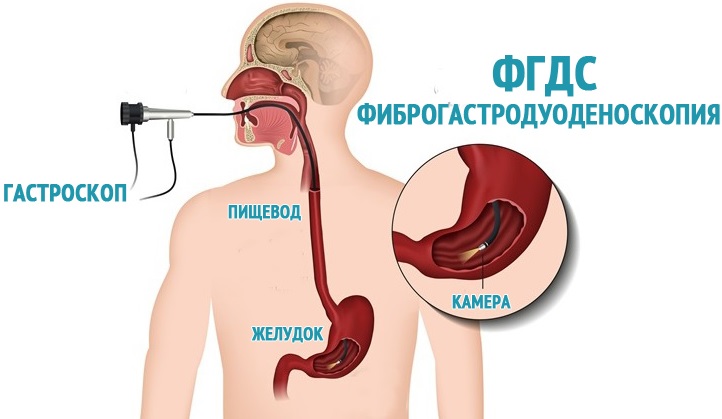 Каков механизм проведения ФГДС? ФГДС