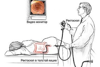 Как проводится ректороманоскопия Осмотр