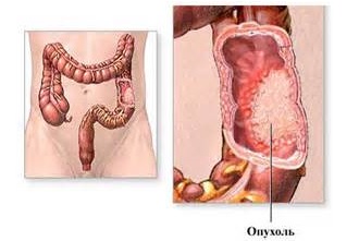 Тубулярная аденома толстой кишки развивается в большинстве случаев у людей, родственники которых страдали этой патологией Аденома