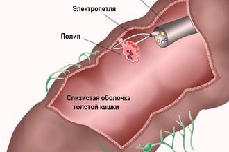 Колоноскопия помогает при удалении полипов Терапия