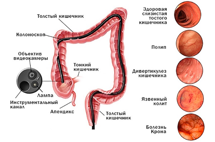 С помощью этого метода выявляется ворсинчатая опухоль прямой кишки, колиты и другие заболевания Колоноскопия