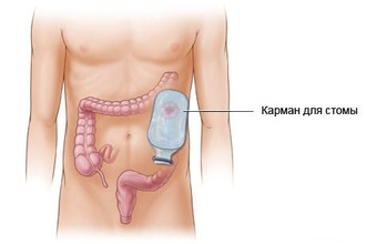 Колостому, или искусственный задний проход, формируют в условиях операционной Колостома