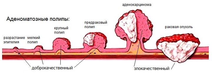 Тубулярно-ворсинчатая аденома толстой кишки способна переродиться в патологическую опухоль Схема
