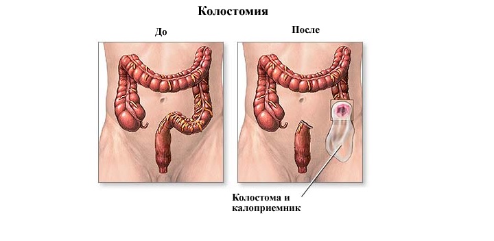 Как проводится закрытие стомы? Схема