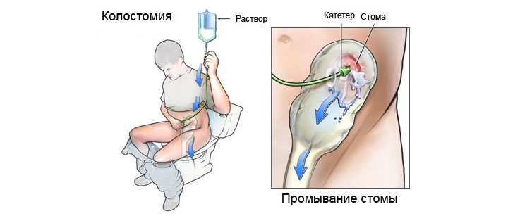 Как используется костолома в реабилитационном периоде? Промывание