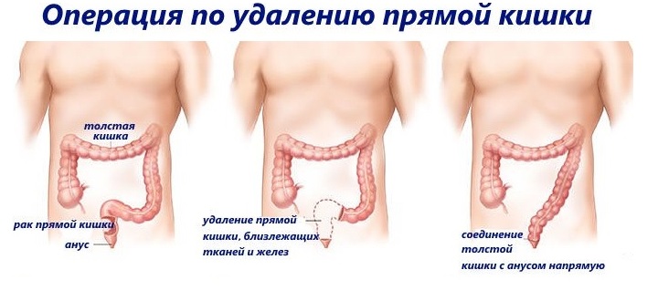 Радикальное удаление прямой кишки Операция