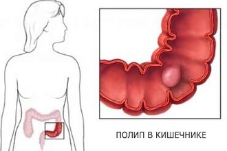 Удаление полипов в прямой кишке осуществляется с применением эндоскопического метода Полип