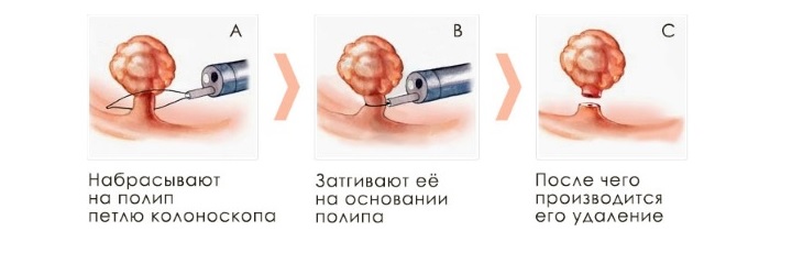 Иссечение полипов в толстой кишке производится инструментом, имеющим диатермическую петлю Полипэктомия