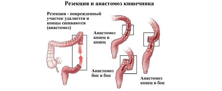 Резекция и анастомоз кишечника при полипах Схема