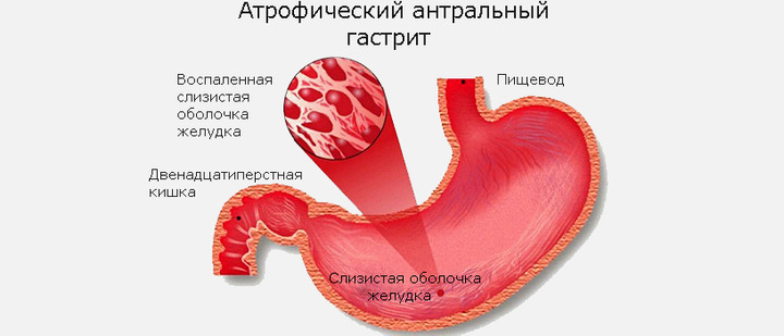 Схематическое изображение антрального атрофического гастрита Антральный атрофический гастрит