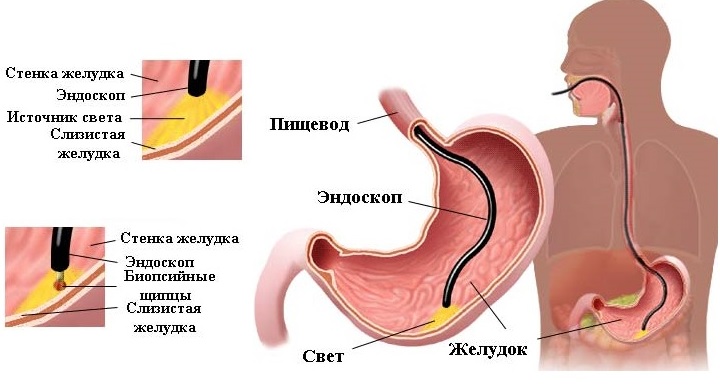 Как проходит гастроскопия желудка без глотания? Схема