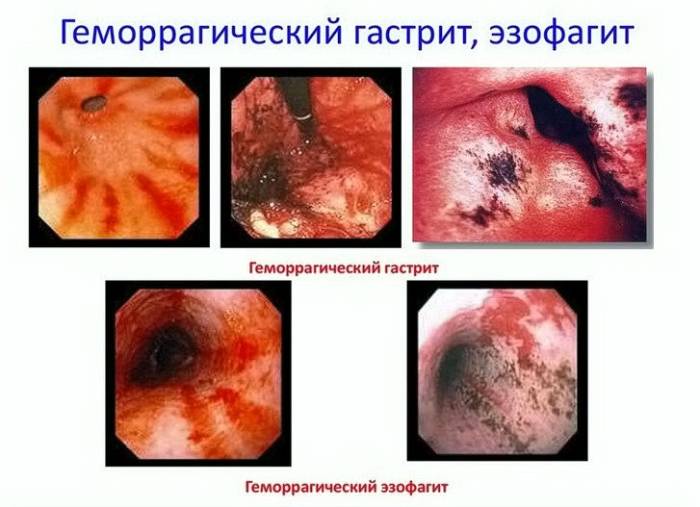 Так выглядит эрозивно-геморрагическая форма гастрита Эрозивно-геморрагическая форма гастрита