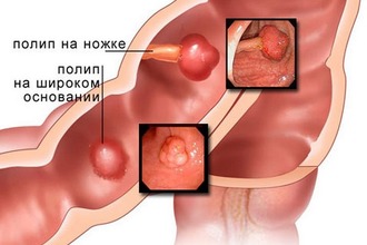 Размеры гиперпластического полипа обычно не превышают 2 см в диаметре Полип