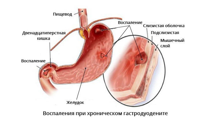Схема воспаления хронического гастродуоденита Хронический гастродуоденит