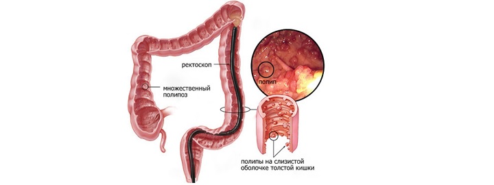 Полипы гиперпластического типа могут отличаться локализацией и распространенностью в желудочно-кишечном тракте Схема