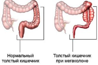Болезнь Гиршпрунга – это врожденная патология, при которой наблюдается мегаколон Мегаколон