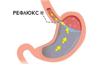 Что такое рефлюкс гастрит? Рефлюкс гастрит