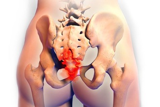 Основное проявление кокцигодинии Кокцигодиния