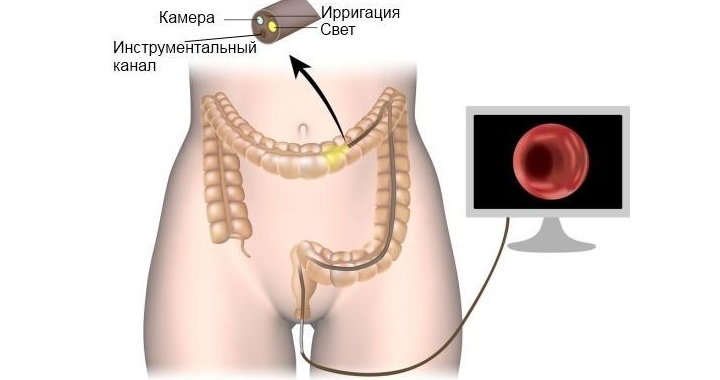 Колоноскопия при болезни Гиршпрунга выполняется выборочно Колоноскопия