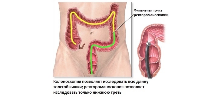 Колоноскопия прямой кишки Диагностика