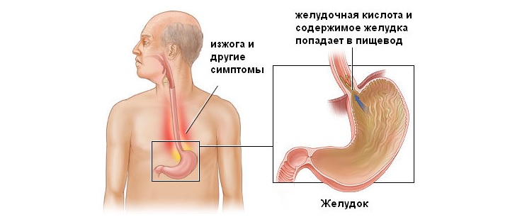 Причины развития изжоги и других симптомов Причины