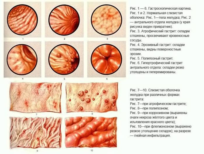Различия между видами гастрита при исследовании Виды гастрита