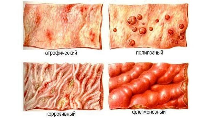 Слизистая оболочка желудка при различных формах гастрита Виды гастрита