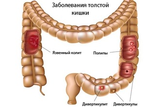 Среди доброкачественных новообразований ободочной кишки полип встречается чаще всего Полип