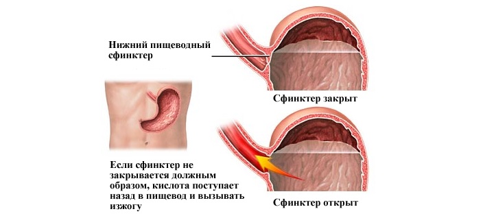 Каковы основные причины появления изжоги? Причины