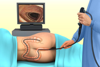 При ирригоскопии визуализируется толстая кишка путем рентгеновского излучения Процедура