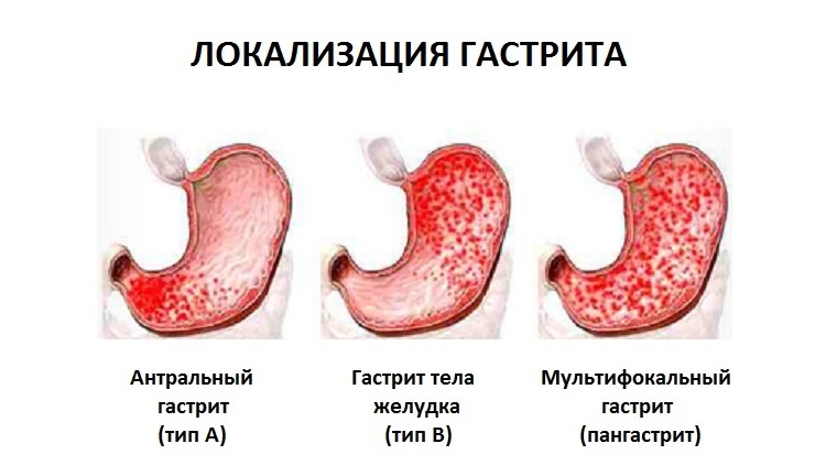 Различие видов гастрита по его локализации Антральный гастрит
