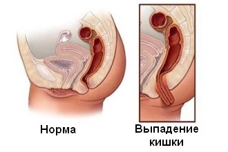 Что представляет собой ректальный пролапс? Выпадение
