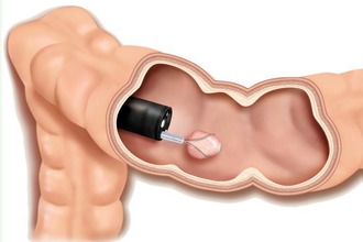 Полипэктомия подразумевает удаление новообразований в пределах слизистой оболочки толстой кишки Удаление