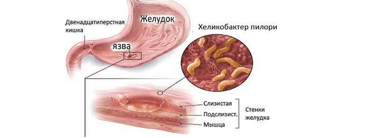 Субатрофический гастрит: что это такое? Схема субатрофического гастрита