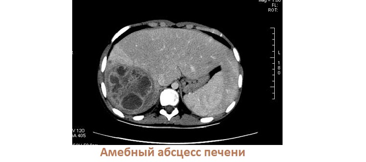 Амебный абсцесс печени