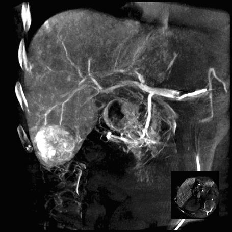 Ангиография печени