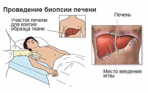 Биопсия печени