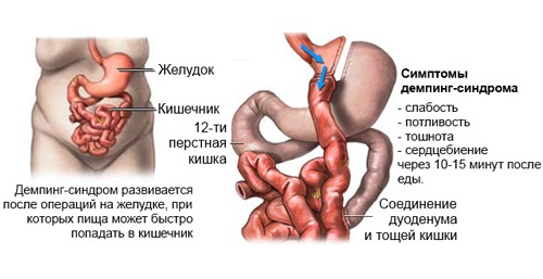 Демпинг-синдром