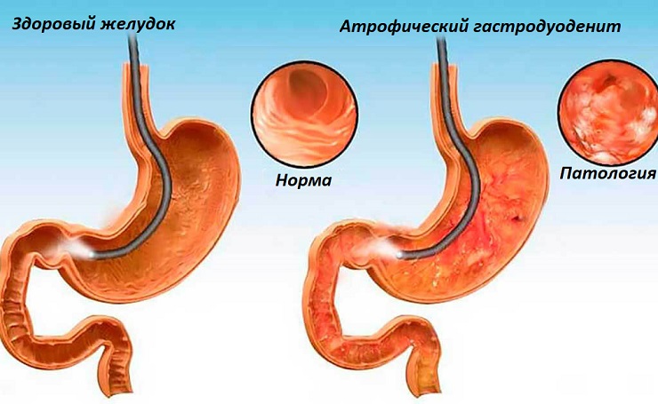 Как выглядит здоровый желудок и атрофический гастродуоденит