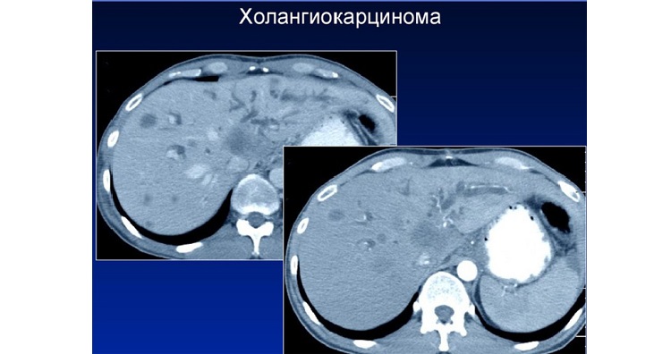 Холангиокарцинома