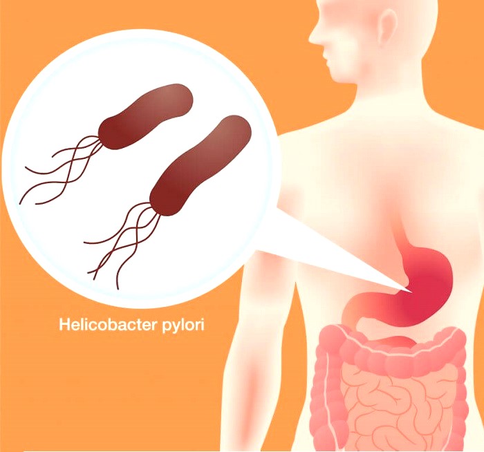Причина хронического бульбита Причина бульбита